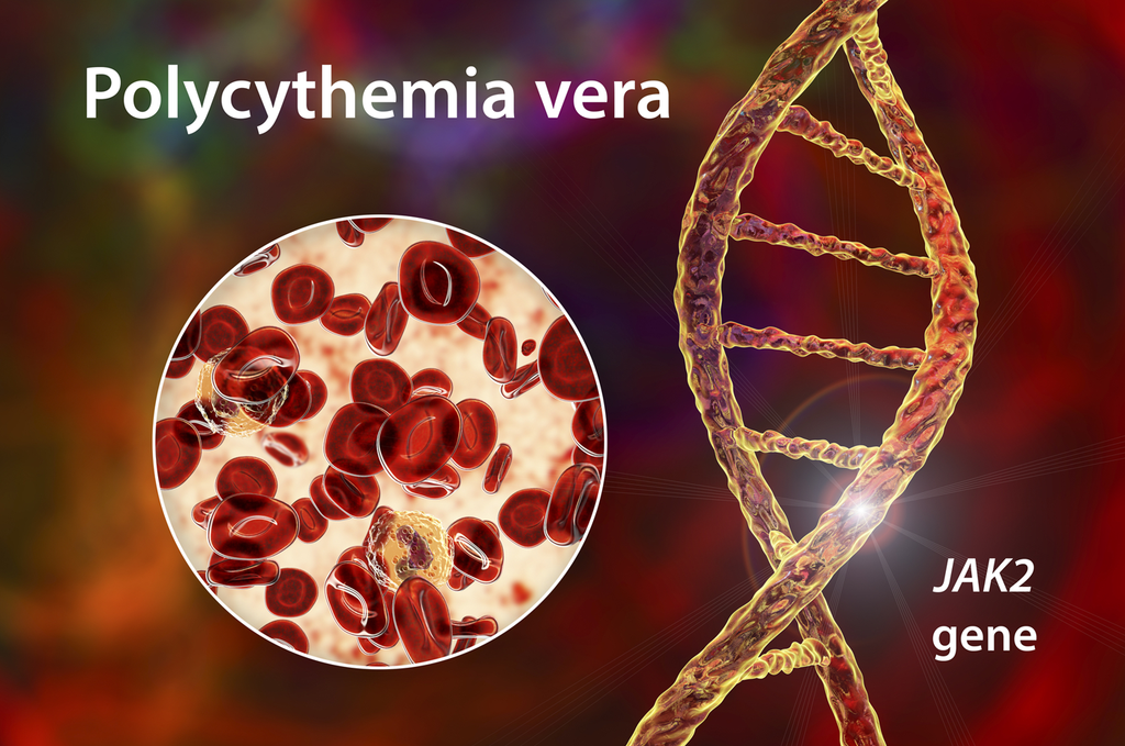 Polycythemia Vera & Radon/Radium Link: Pennsylvania Case Study
